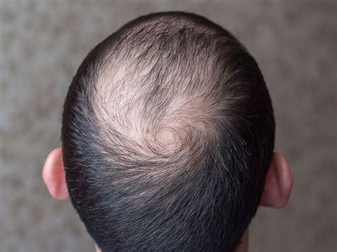 Hair Loss Caused By Infections The Toronto Hair Transplant Clinic