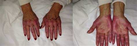 The Patient S Hands Showing Unilateral Hand Foot Synd