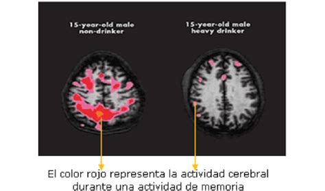 Daños del alcohol al cerebro Cuáles son