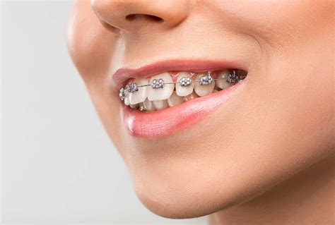 How Do Braces Work To Straighten Your Teeth Nearest Dental Clinic