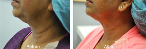 Non Surgical Neck Lift Ny Before And After Pictures
