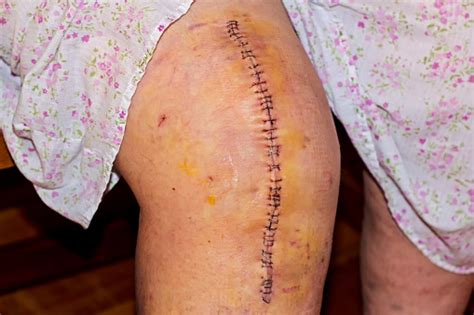 Maybe you would like to learn more about one of these? Scar From Knee Replacement Operation Stock Photo ...