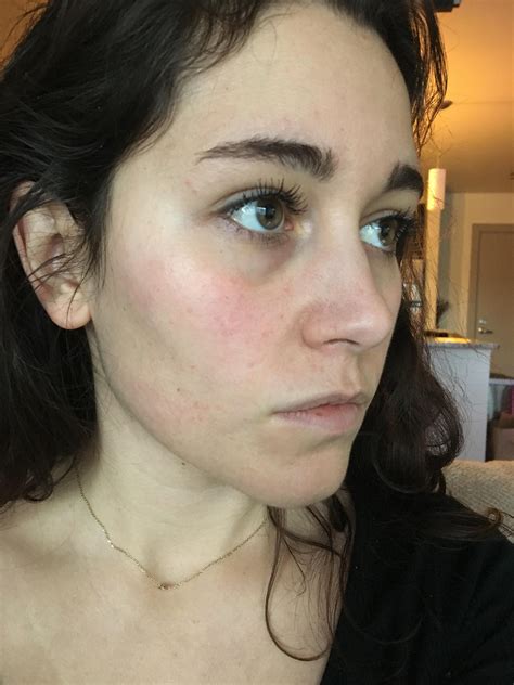 Skin Concerns What Are These Flat Red Dots All Over My Cheeks Skin