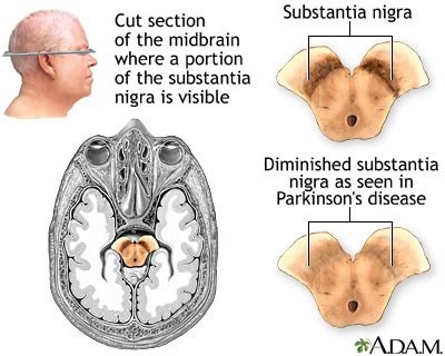 Making the correct diagnosis can be challenging as many conditions—including tremor, gait and atypical. Substantia nigra and Parkinson disease: MedlinePlus Medical Encyclopedia Image