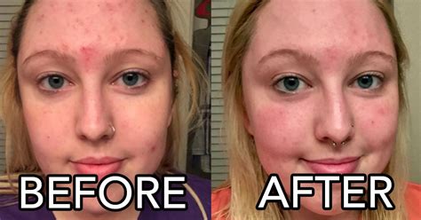 Vitamin c supplement for skin before and after. This Vitamin C Face Serum May Give You The Best Dang Skin ...
