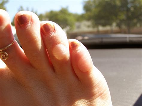 Blisters On Toes Pictures Causes And Treatment