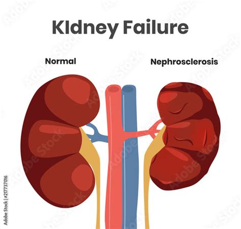 Vector Illustration Of The Kidney Failure Normal Kidney Versus Kidney
