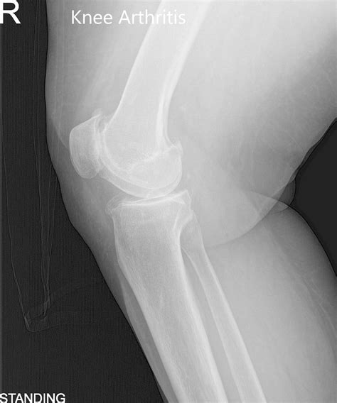 Case Study Unilateral Knee Replacement In 74 Yr Old Female