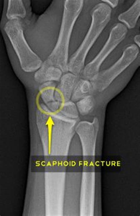 Learn when to see a doctor, how it is diagnosed and treatment options. Broken wrist and The o'jays on Pinterest