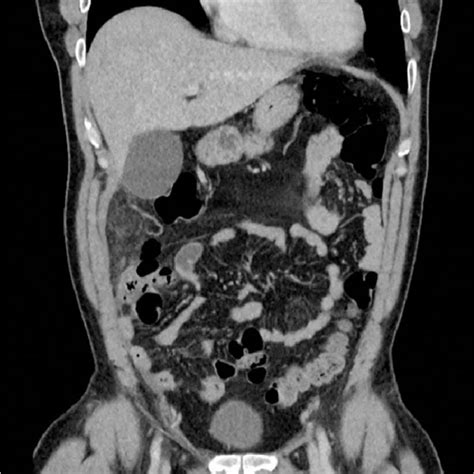 Abdominal Ct Demonstrating Soft Tissue Stranding Anterio Lateral To The