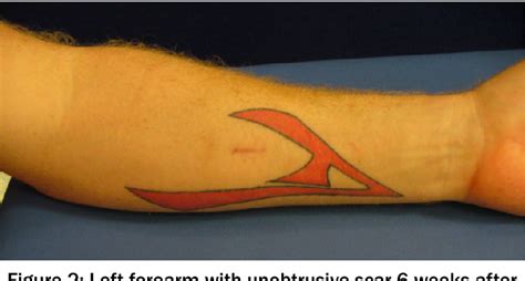 Figure 2 From Endoscopic Fasciotomy In Chronic Exertional Compartment Syndrome Of The Forearm