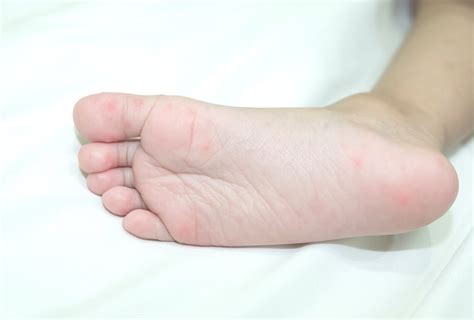 脚上的红斑原因和如何治疗 Beplay官