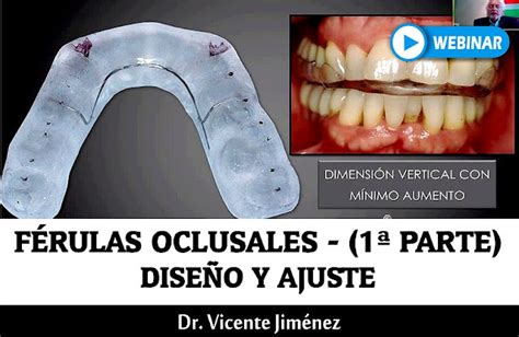 Webinar Férulas Oclusales Diseño Y Ajuste 1ª Parte Dr Vicente