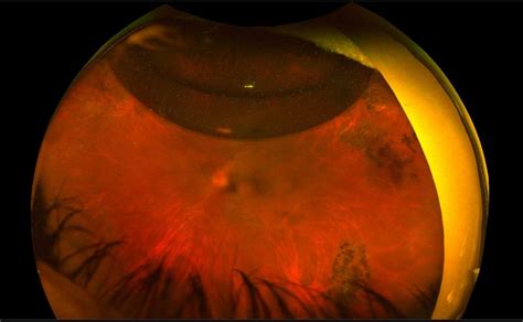 Intraocular Gases And Oil Macula Retina Vitreous Center