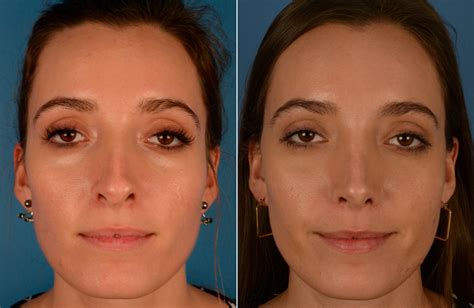 Revision Rhinoplasty Photos Naples Fl Patient 13736