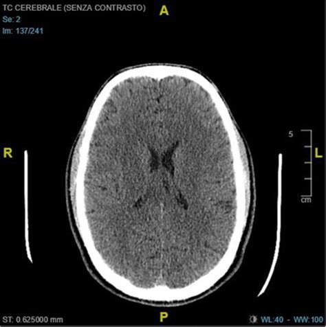 View Normal Brain Ct Scan Images Us