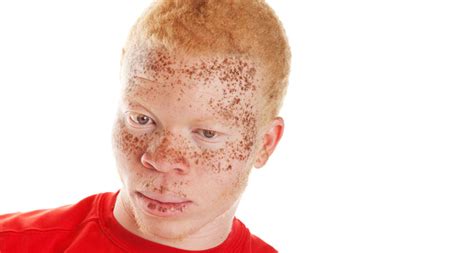 Do Young People Get Skin Cancer Cancerwalls