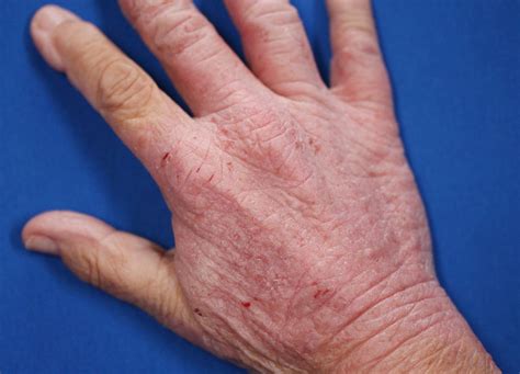 Eczema On Hands Types