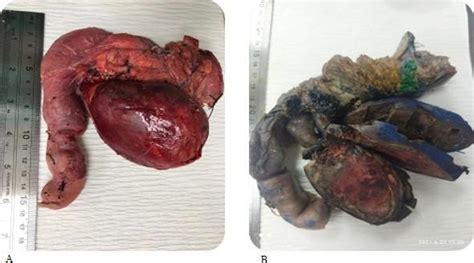 Tumor Cabeza Pancreas Cirugia Ocronos Editorial Cient Fico T Cnica