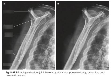 C6 Shoulder Scapular Y PA Oblique Diagram Quizlet