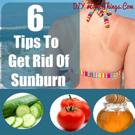 6 Tips To Get Rid Of Sunburn Get Rid Of Sunburn Sunburn Natural