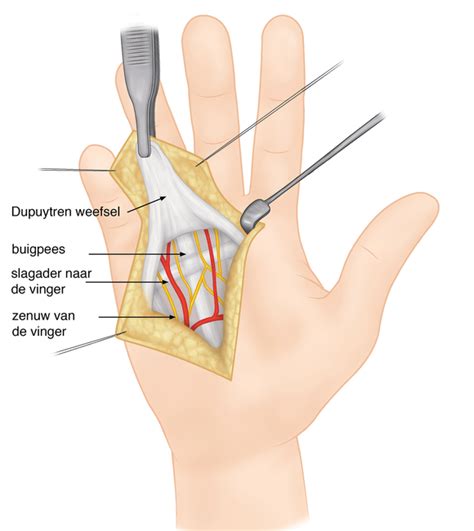 Wat Is De Ziekte Van Dupuytren Dokter Jacobs