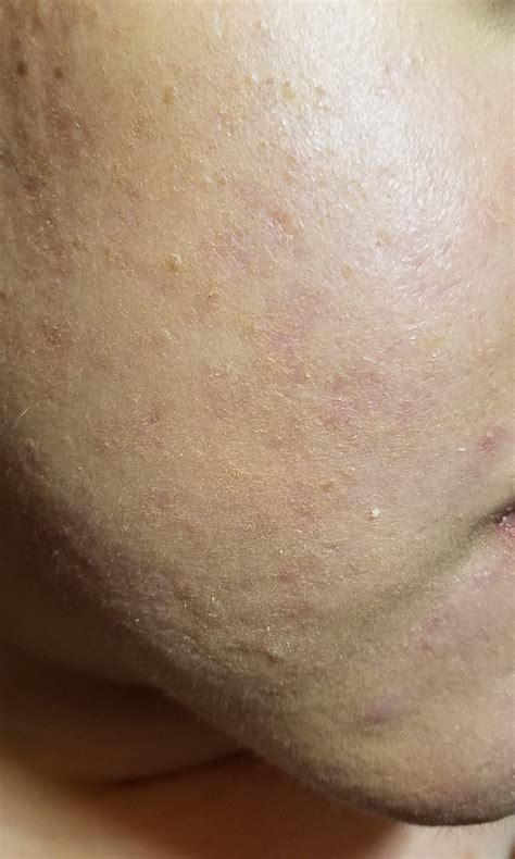 [Skin Concerns] My dry skin on my cheeks area is seriously embarrassing ...