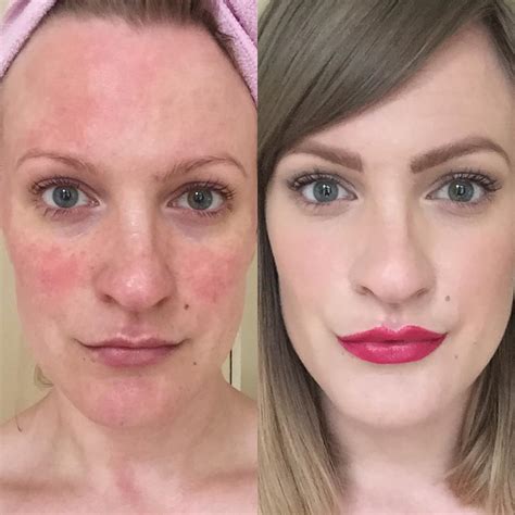 5 Celebrities You Didnt Know Have Rosacea Plus 5 Products To Help