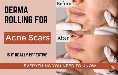 Derma Rolling For Acne Scars Everything You Should Know Sasily Skin