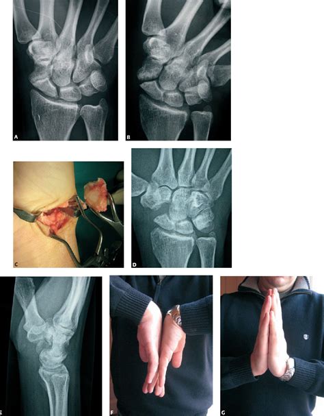 33 Open Resection Of The Distal Pole Of The Scaphoid Musculoskeletal Key