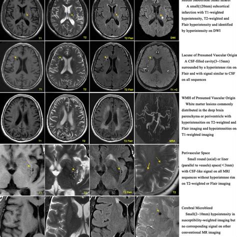 Neuroimaging Characteristics Of Cerebral Small Vessel Diseases In Mri