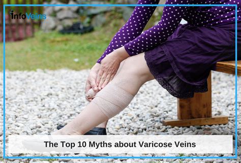 The Top 10 Myths About Varicose Veins Azura Vascular Care