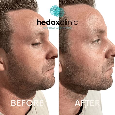 Weak Chin Treatment London Jawline Fillers Hedox Clinic