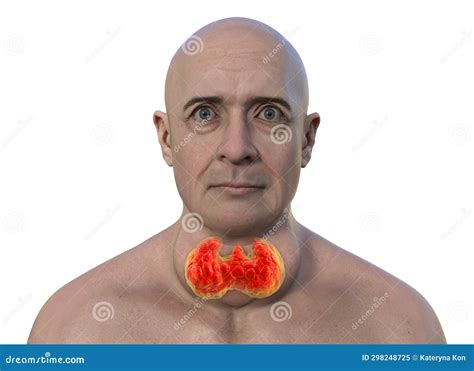 A Man With Enlarged Thyroid Gland 3d Illustration Stock Illustration