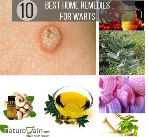 10 Effective And Best Home Remedies For Warts