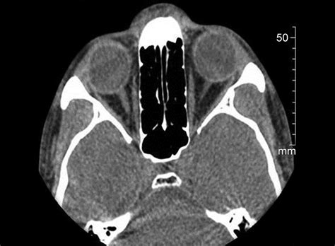 CT Scan Of Paranasal Sinus Axial View Showing Normal Ethmoid Sinus Download Scientific Diagram