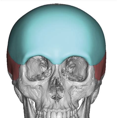 Plastic Surgery Case Study Male Custom Forehead Brow Bone Implant