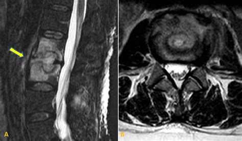 A Sagittal T2 Stirshort Ti Inversion Recovery Weighted Sequence And