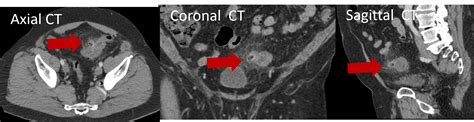 Left Lower Quadrant Abdominal Pain Radiology