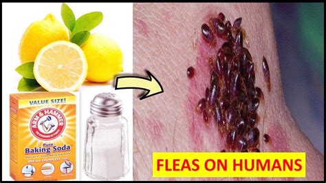 how to get rid of fleas on humans the easy and inexpensive way natural home remedies youtube