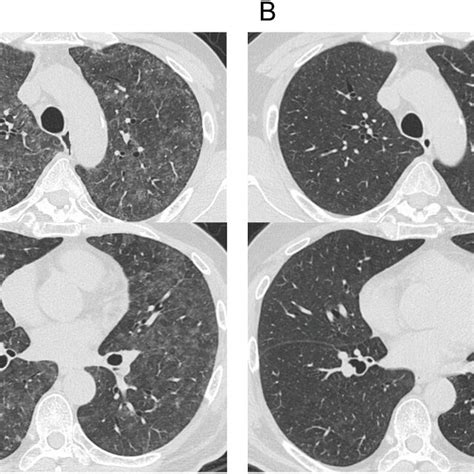 High Resolution Computed Tomography Hrct Images Of The Lung A Hrct