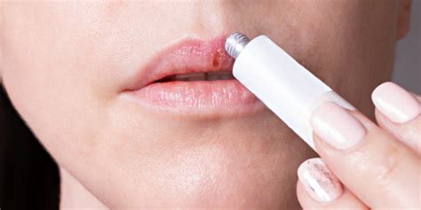 How To Get Rid Of Lip Pimple Useful Tips