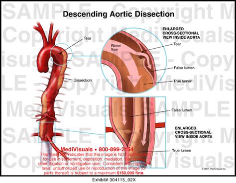 Descending Aortic Dissection Medical Exhibit Medivisuals