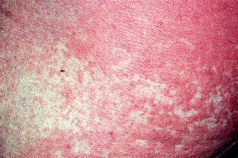 Skin Peeling In Allergic Reaction Photograph By Dr P Marazziscience