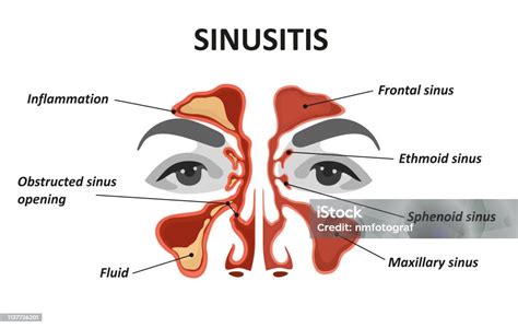 Sinusitis Stock Illustration Download Image Now Sinusitis