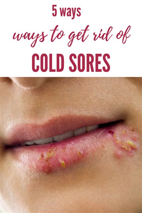How To Get Rid Of Cold Sores Beauty Services At Home Cold Sore Get