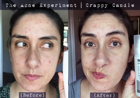 Paulas Choice Glycolic Acid Review The Acne Experiment Crappy Candle