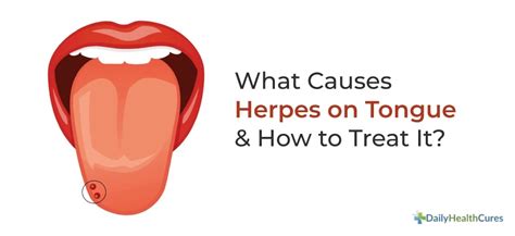 This picture shows herpes lesions in the later stages of healing. Herpes on Tongue: Symptoms, Causes, Stages & Treatment Options
