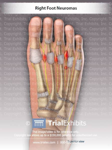 Right Foot Neuromas Trialexhibits Inc