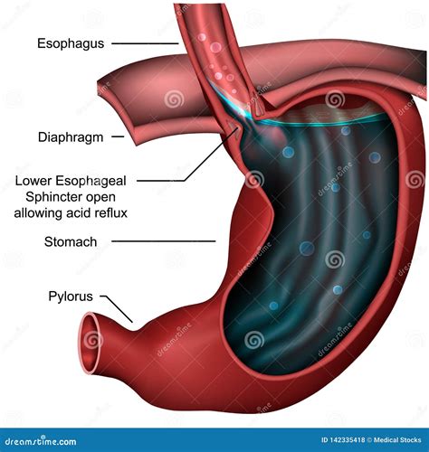 Esophageal Sphincter Anatomy Reflux 3d Medical Illustration Stock